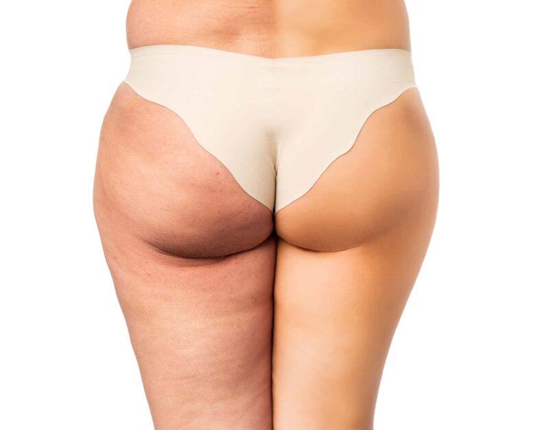 rimedi contro la cellulite cellulite rimedio
