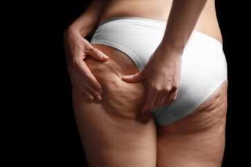 cellulite rimedio