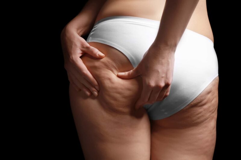 cellulite rimedio