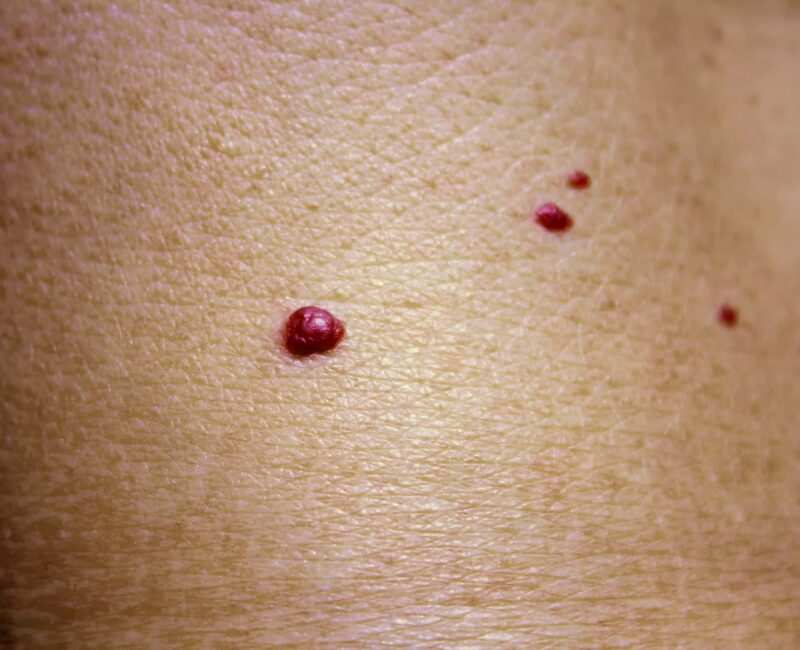 Nei rossi, Angioma rubino rimedi naturali Rete News