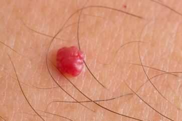 angioma rubino nei rossi