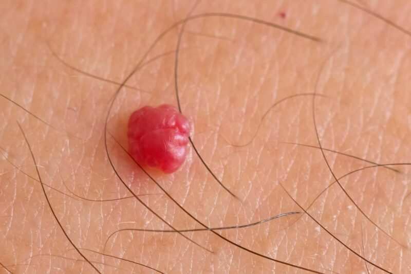 angioma rubino nei rossi