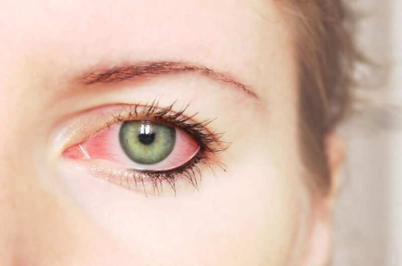 Occhi irritati per Allergia al cloro