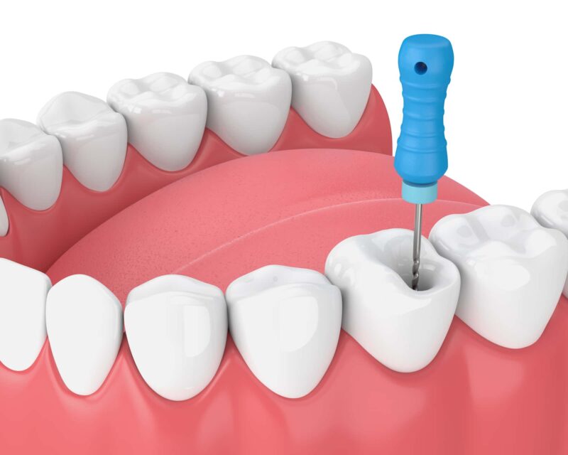 endodonzia endodonzia
