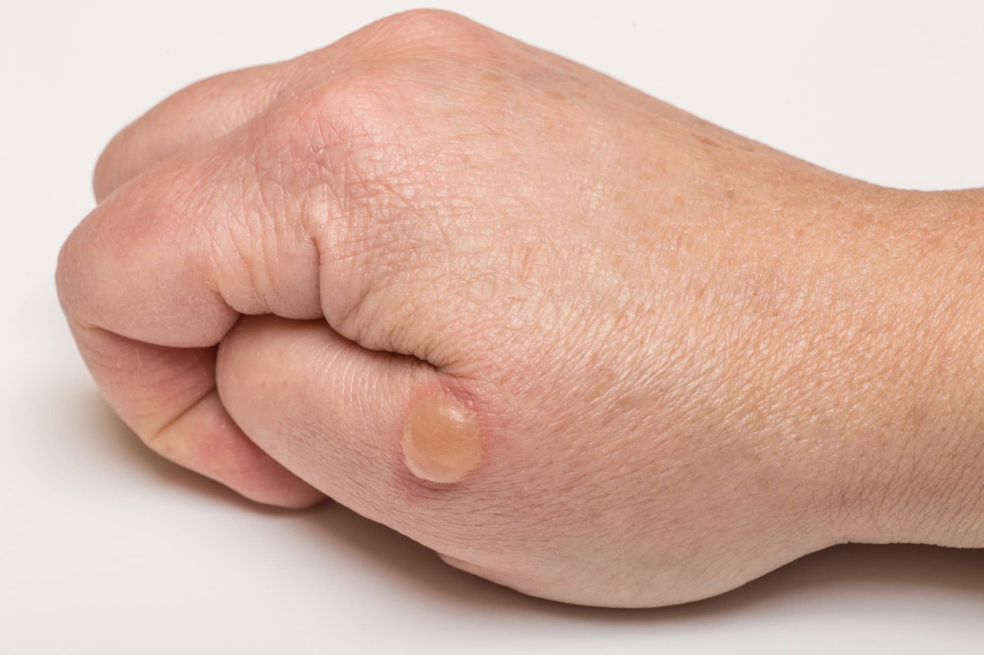 ustione alla mano con vescica